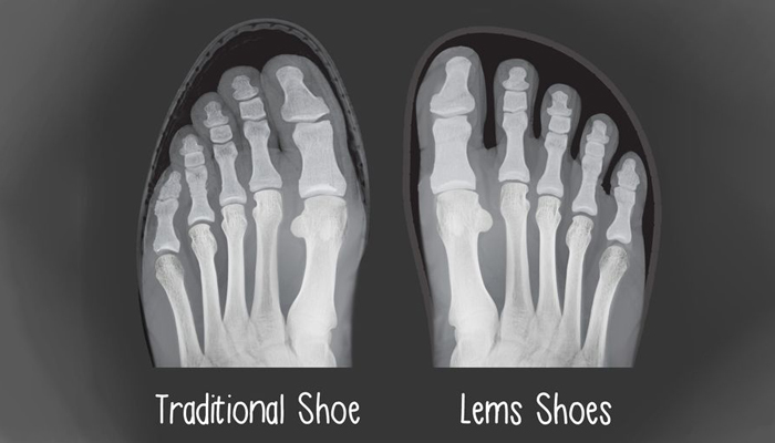 کفش نامناسب و درد پا